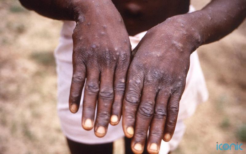 'An extraordinary situation' - WHO declares monkeypox a global health emergency